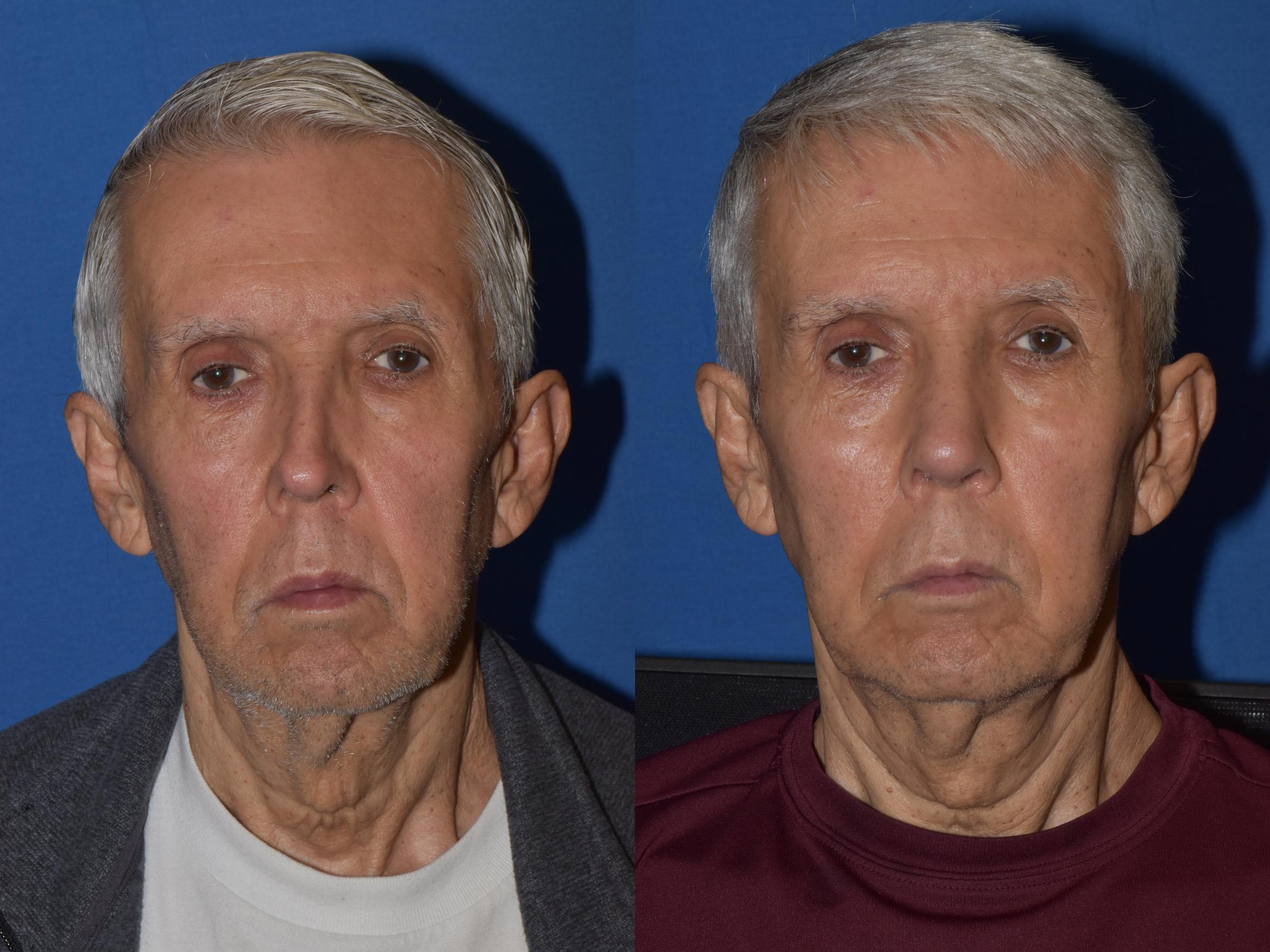 Before & After Revision Rhinoplasty Case 17 Front View in South Miami, Florida