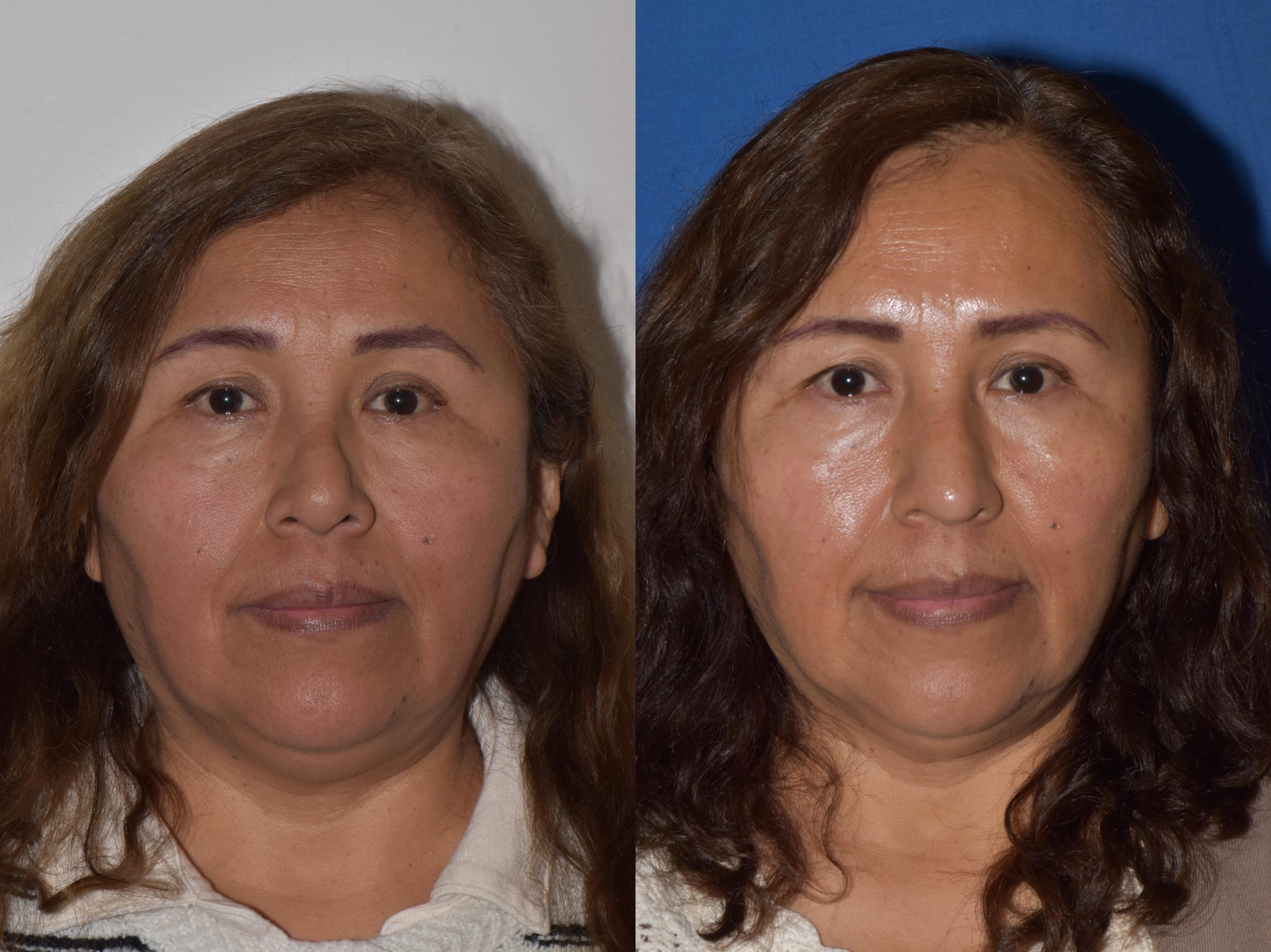 Before & After Revision Rhinoplasty Case 18 Front View in South Miami, Florida