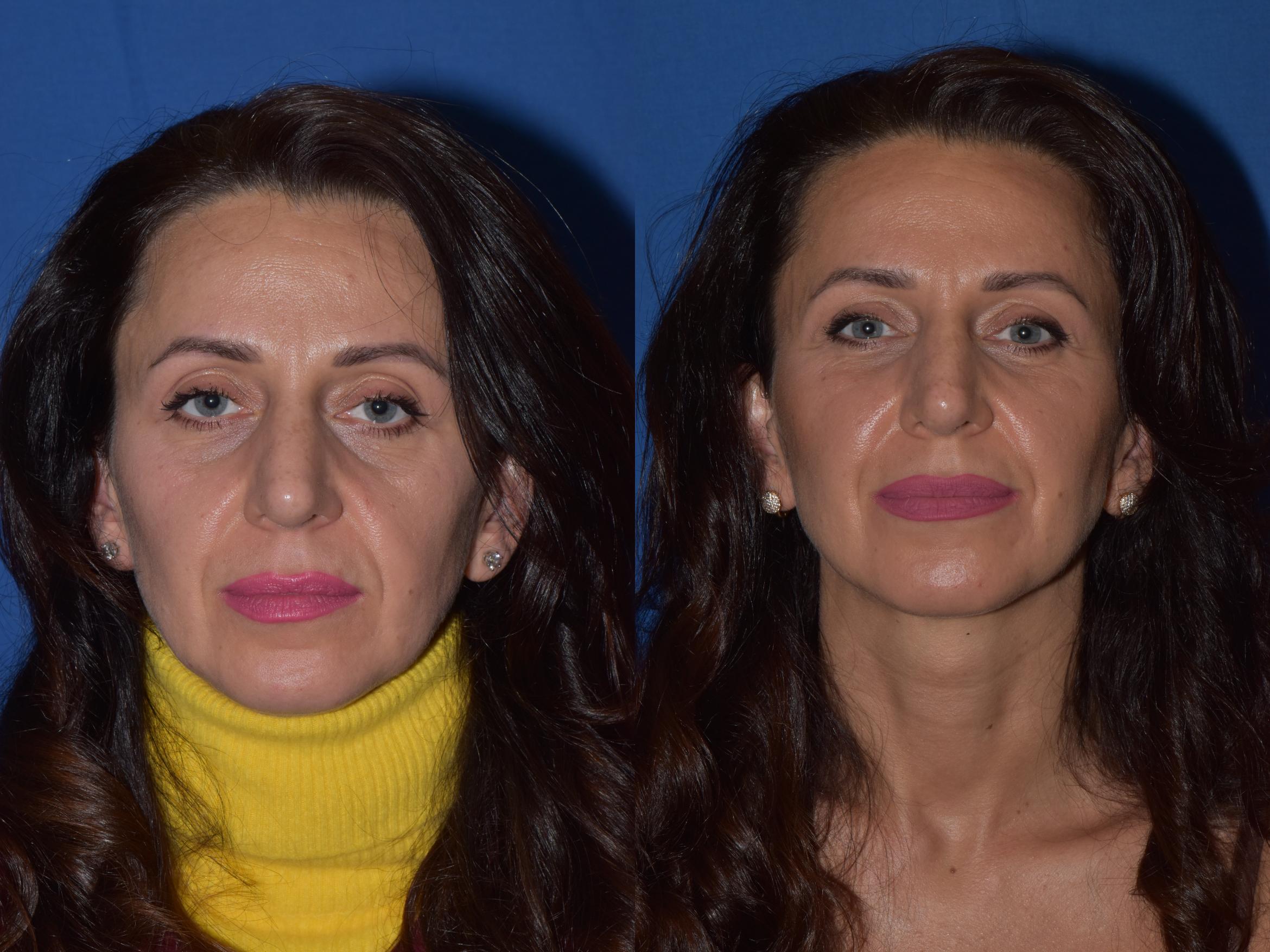 Before & After Revision Rhinoplasty Case 19 Front View in South Miami, Florida