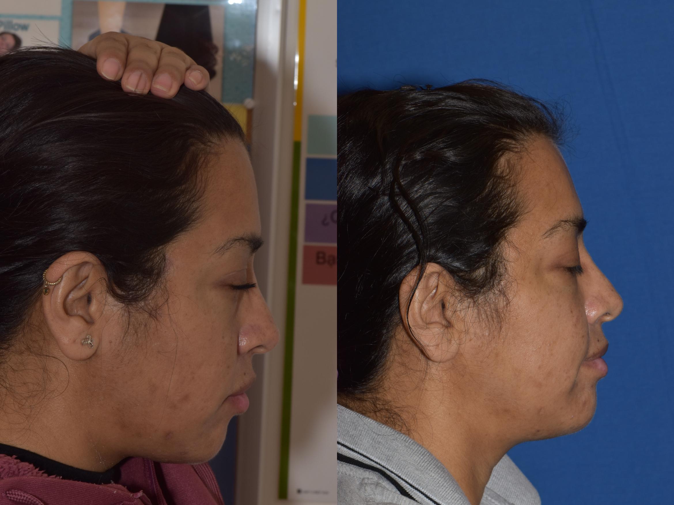 Before & After Reconstruction Case 20 Right Side View in South Miami, Florida