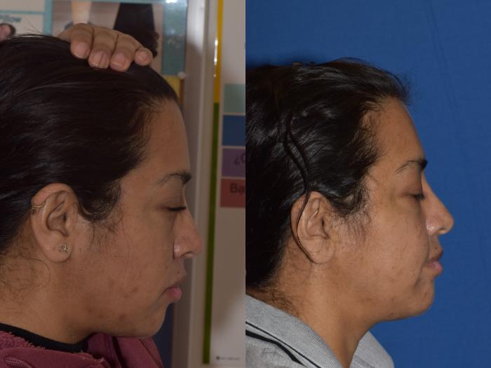 Before & After Reconstruction Case 20 Right Side View in South Miami, Florida