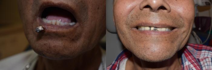 Before & After Reconstruction Case 21 Left Oblique View in South Miami, Florida