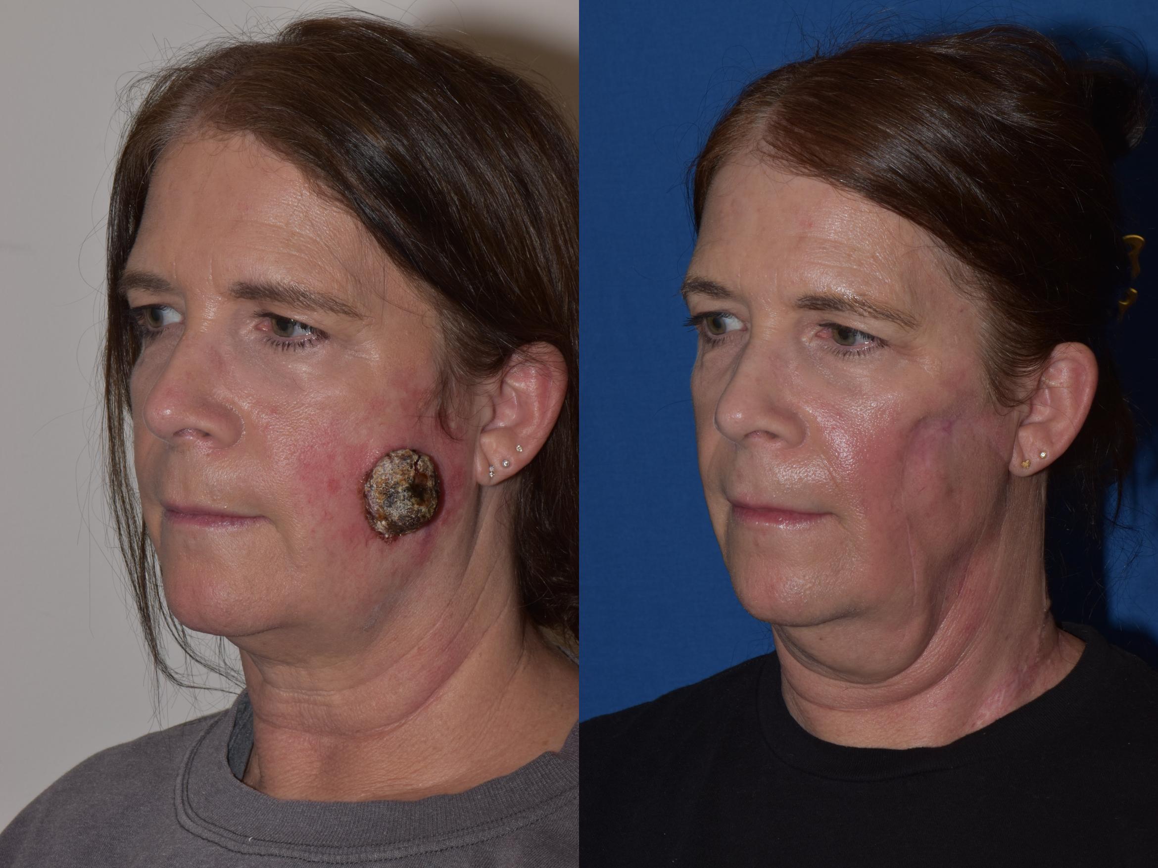 Before & After Reconstruction Case 22 Left Oblique View in South Miami, Florida