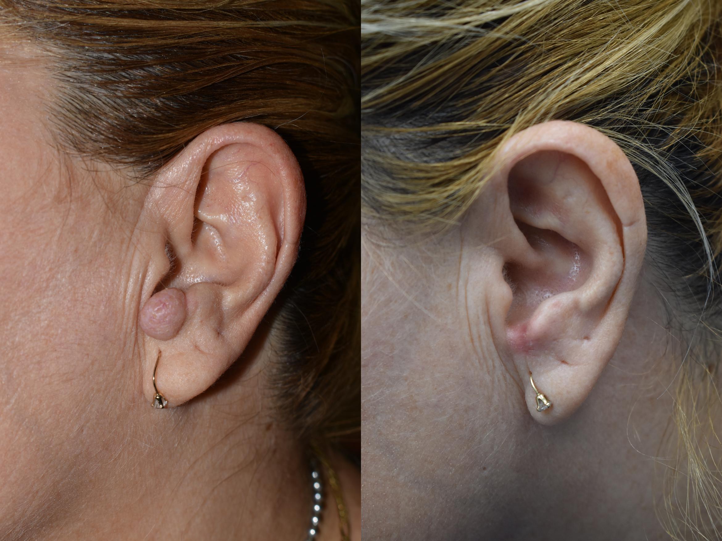 Before & After Reconstruction Case 5 Left Side View in South Miami, Florida