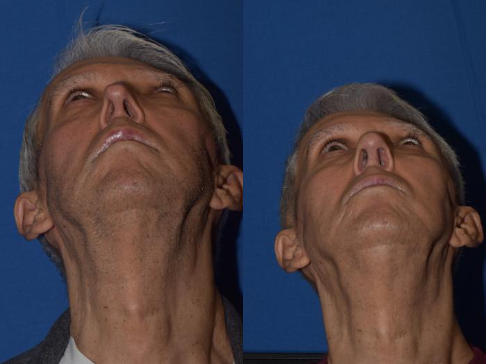 Before & After Revision Rhinoplasty Case 17 Bottom View in South Miami, Florida