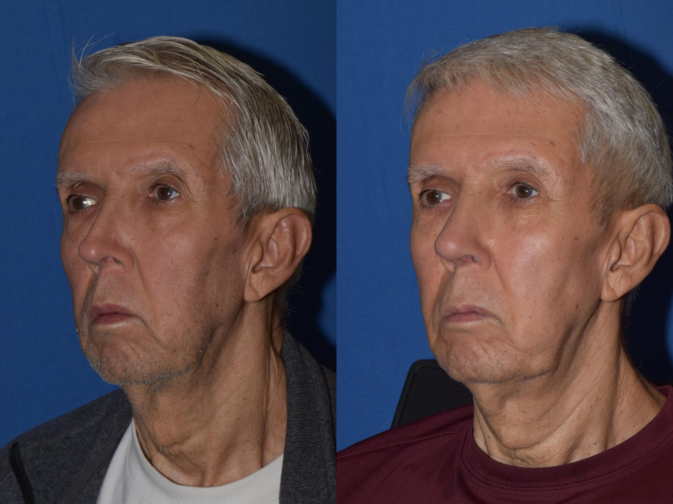 Before & After Revision Rhinoplasty Case 17 Left Oblique View in South Miami, Florida