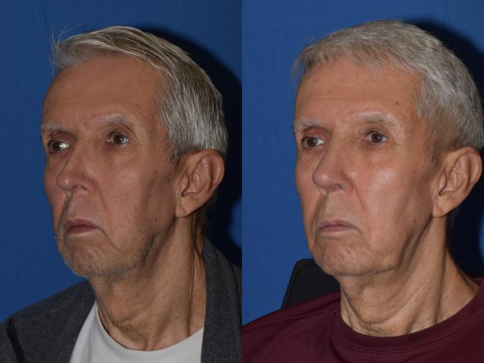 Before & After Revision Rhinoplasty Case 17 Left Oblique View in South Miami, Florida