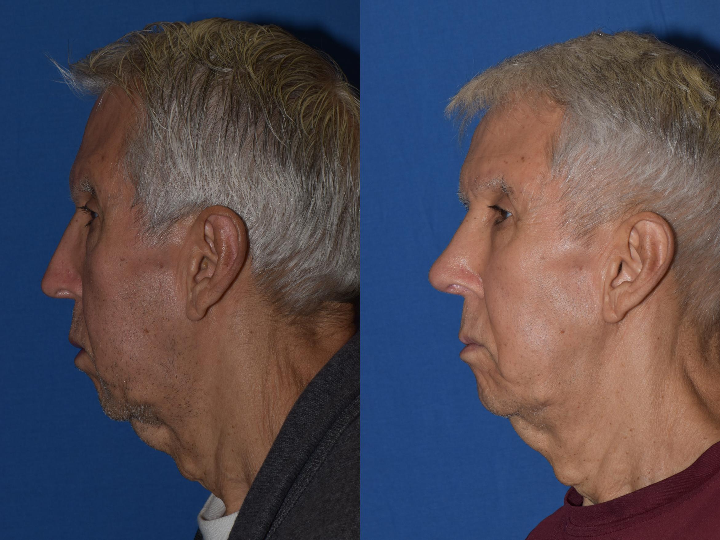 Before & After Revision Rhinoplasty Case 17 Left Side View in South Miami, Florida