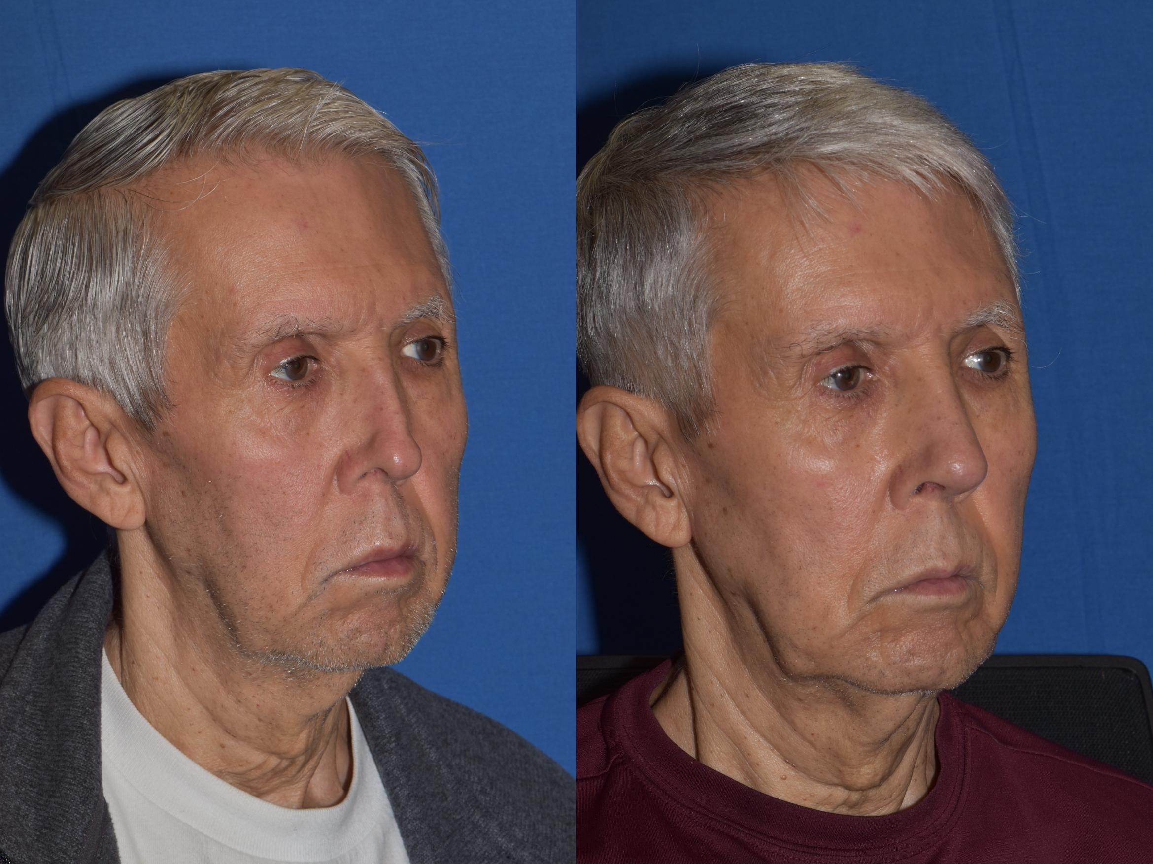 Before & After Revision Rhinoplasty Case 17 Right Oblique View in South Miami, Florida