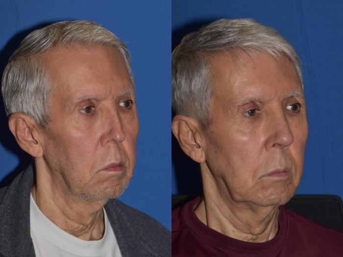 Before & After Revision Rhinoplasty Case 17 Right Oblique View in South Miami, Florida