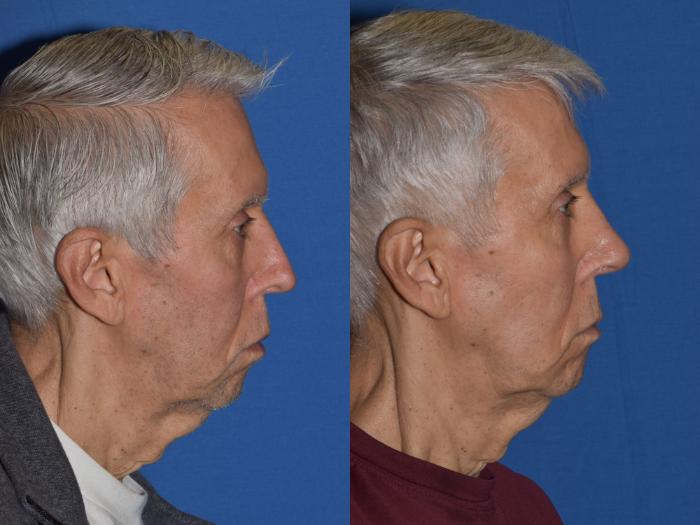 Before & After Revision Rhinoplasty Case 17 Right Side View in South Miami, Florida