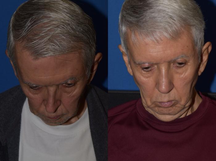 Before & After Revision Rhinoplasty Case 17 Top View in South Miami, Florida