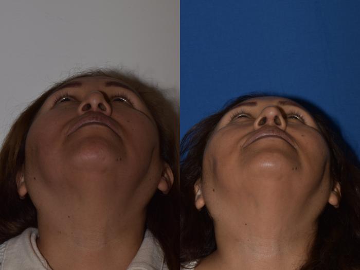 Before & After Revision Rhinoplasty Case 18 Bottom View in South Miami, Florida
