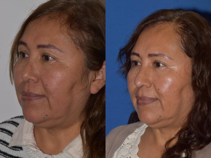 Before & After Revision Rhinoplasty Case 18 Left Oblique View in South Miami, Florida
