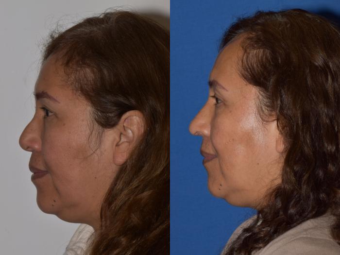 Before & After Revision Rhinoplasty Case 18 Left Side View in South Miami, Florida