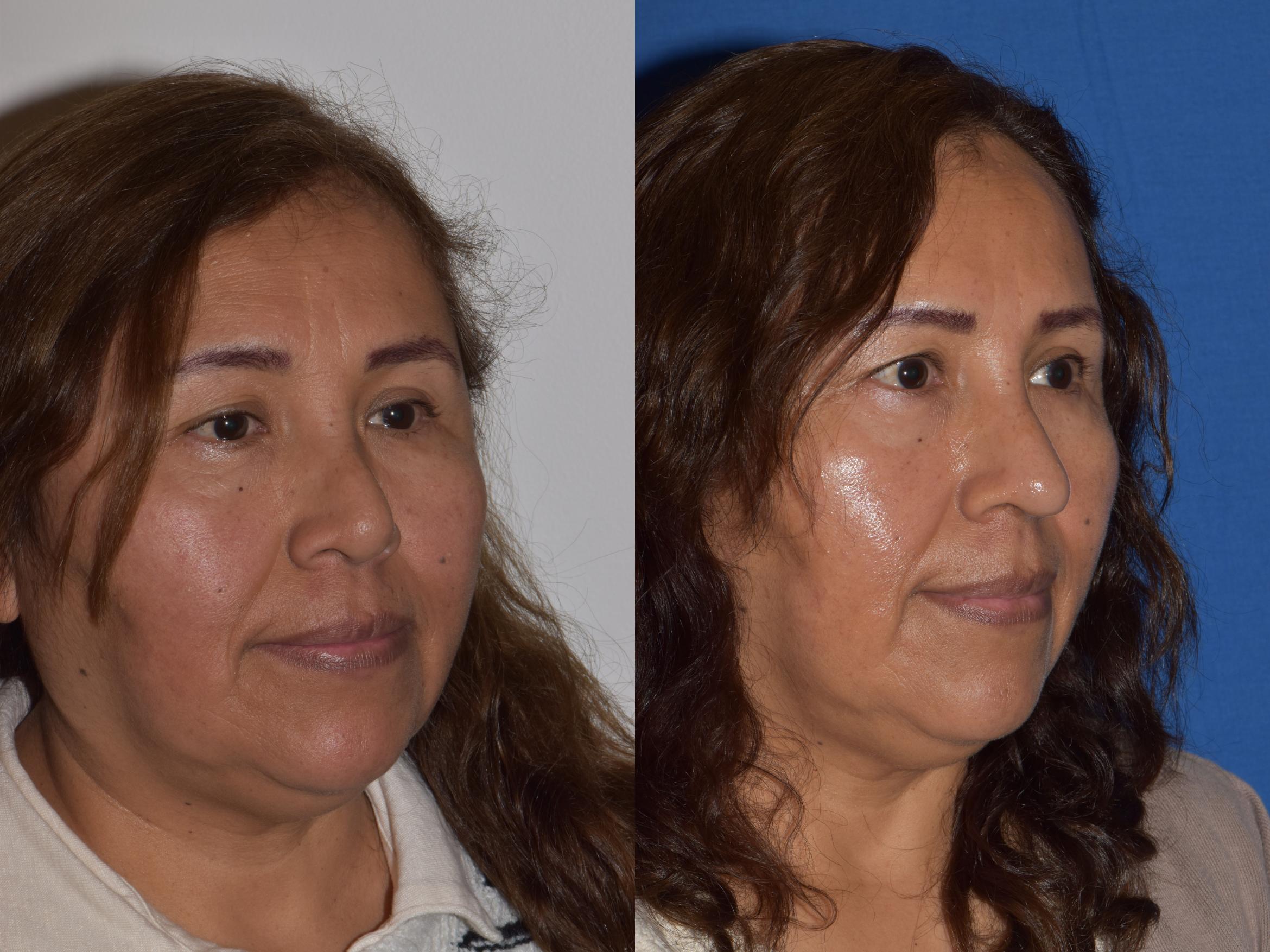 Before & After Revision Rhinoplasty Case 18 Right Oblique View in South Miami, Florida