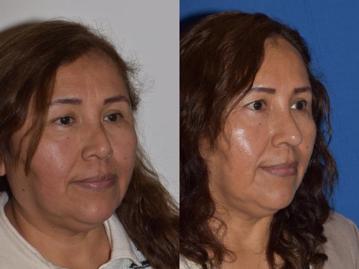 Before & After Revision Rhinoplasty Case 18 Right Oblique View in South Miami, Florida