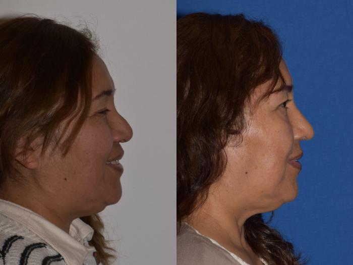 Before & After Revision Rhinoplasty Case 18 Right Side Smiling View in South Miami, Florida