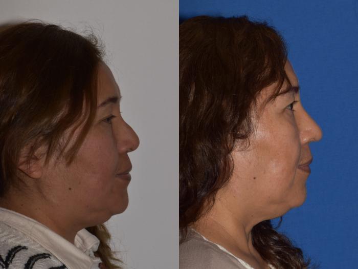 Before & After Revision Rhinoplasty Case 18 Right Side View in South Miami, Florida