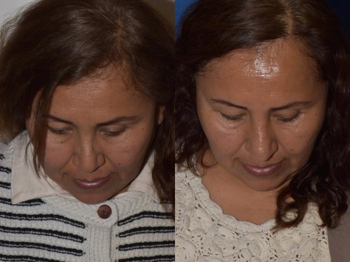 Before & After Revision Rhinoplasty Case 18 Top View in South Miami, Florida