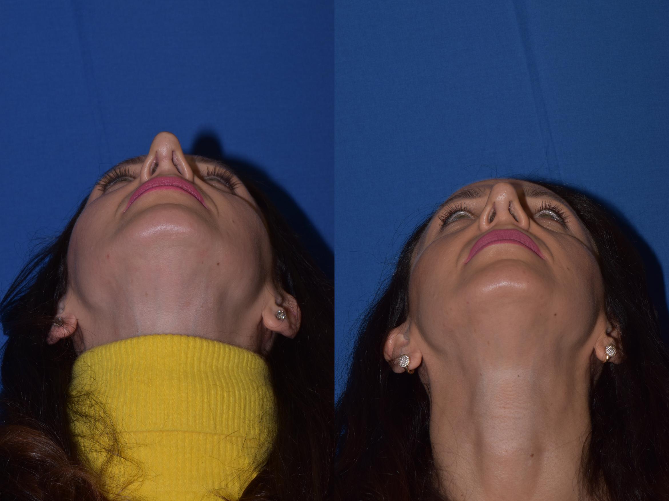 Before & After Revision Rhinoplasty Case 19 Bottom View in South Miami, Florida