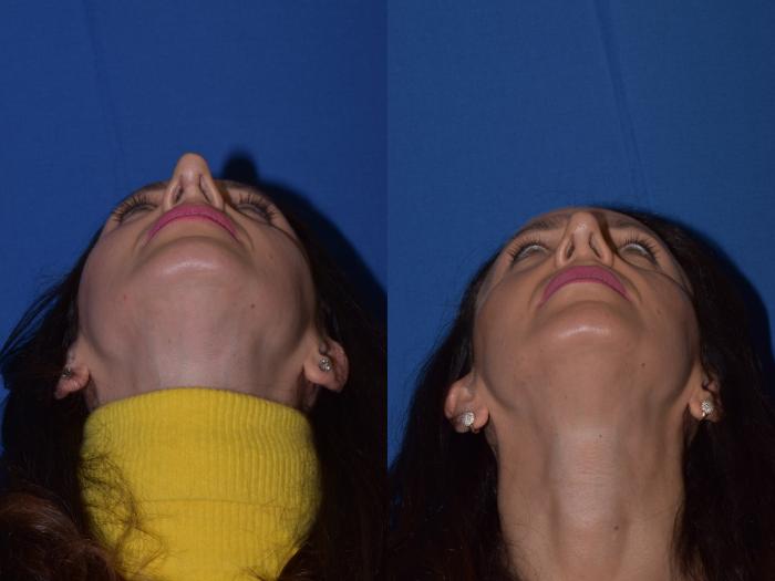 Before & After Revision Rhinoplasty Case 19 Bottom View in South Miami, Florida