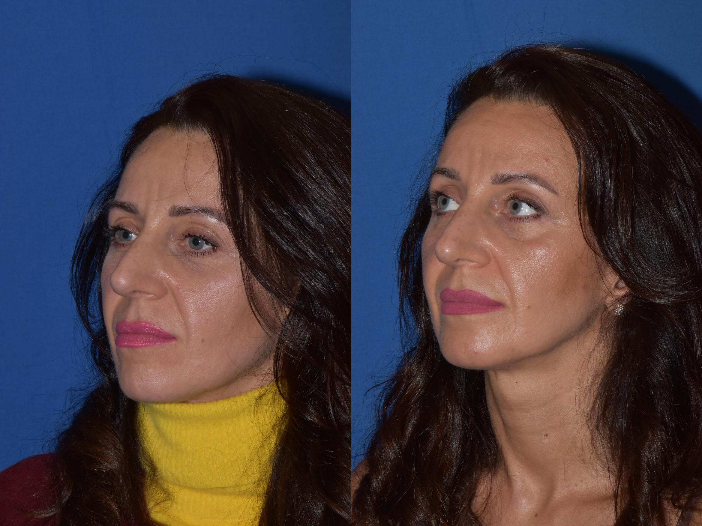 Before & After Revision Rhinoplasty Case 19 Left Oblique View in South Miami, Florida