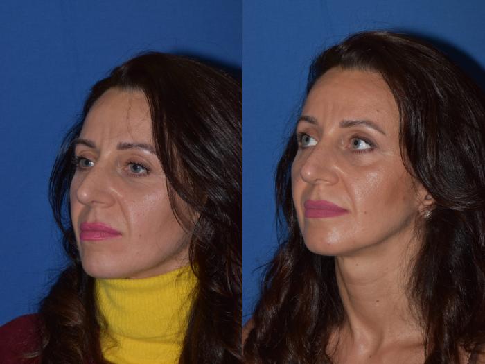 Before & After Revision Rhinoplasty Case 19 Left Oblique View in South Miami, Florida