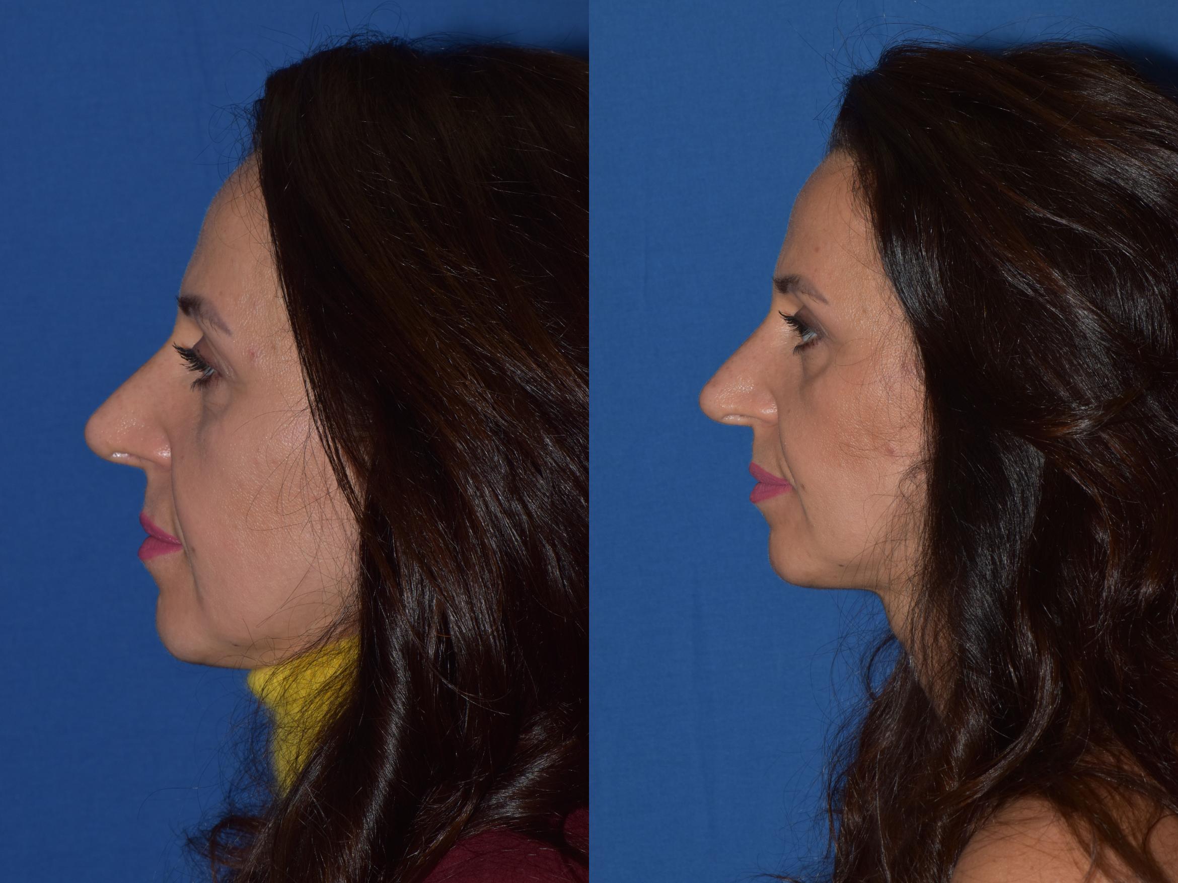 Before & After Revision Rhinoplasty Case 19 Left Side View in South Miami, Florida