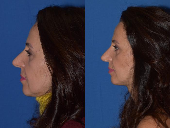 Before & After Revision Rhinoplasty Case 19 Left Side View in South Miami, Florida
