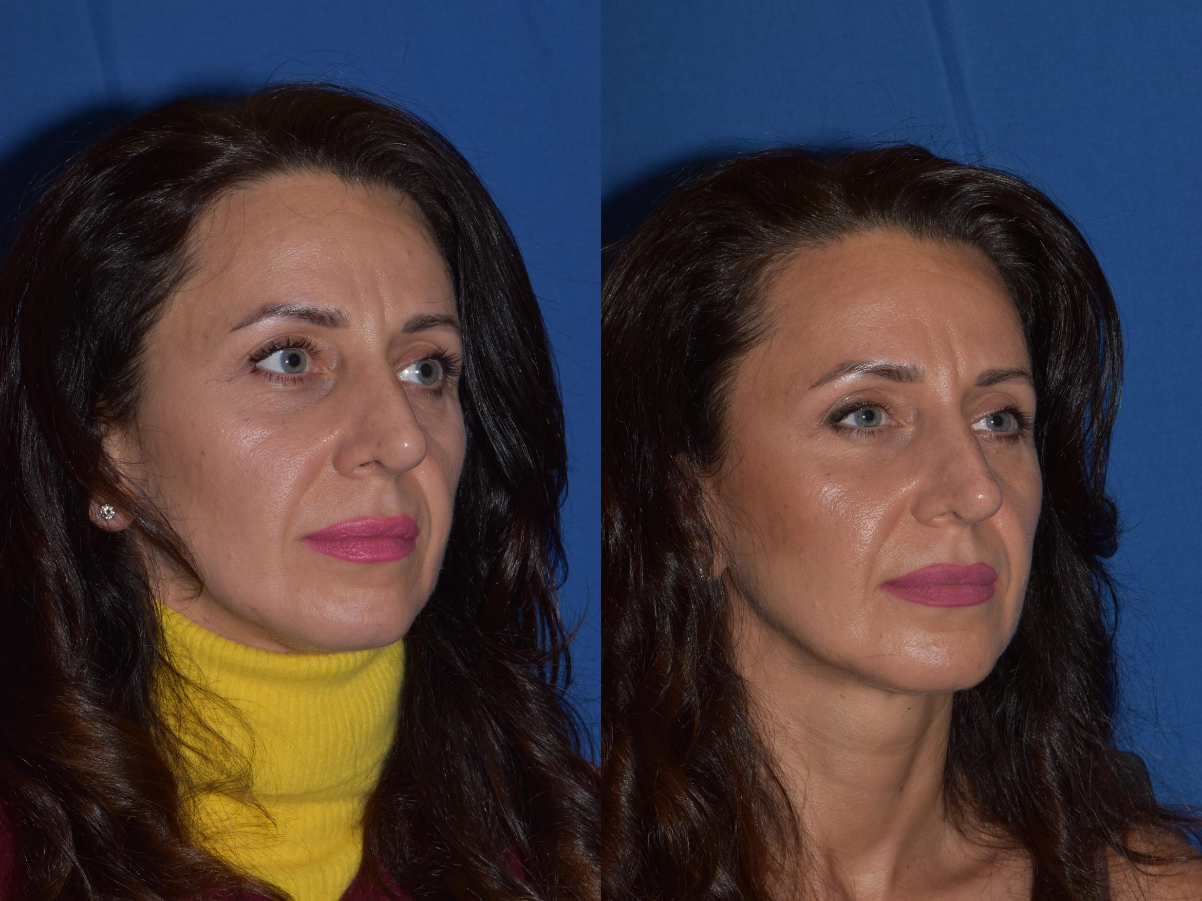 Before & After Revision Rhinoplasty Case 19 Right Oblique View in South Miami, Florida