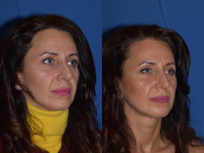 Before & After Revision Rhinoplasty Case 19 Right Oblique View in South Miami, Florida