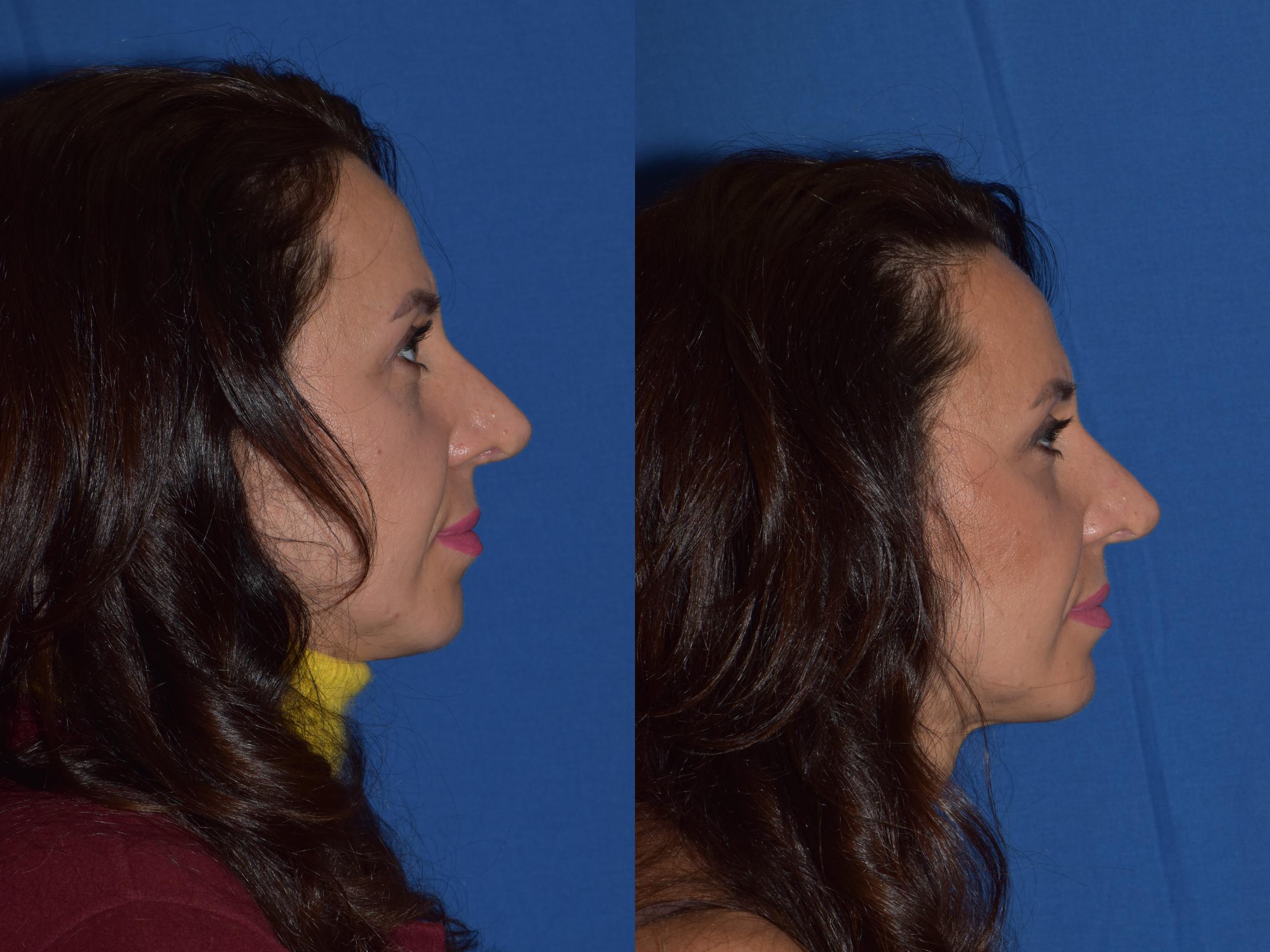 Before & After Revision Rhinoplasty Case 19 Right Side View in South Miami, Florida