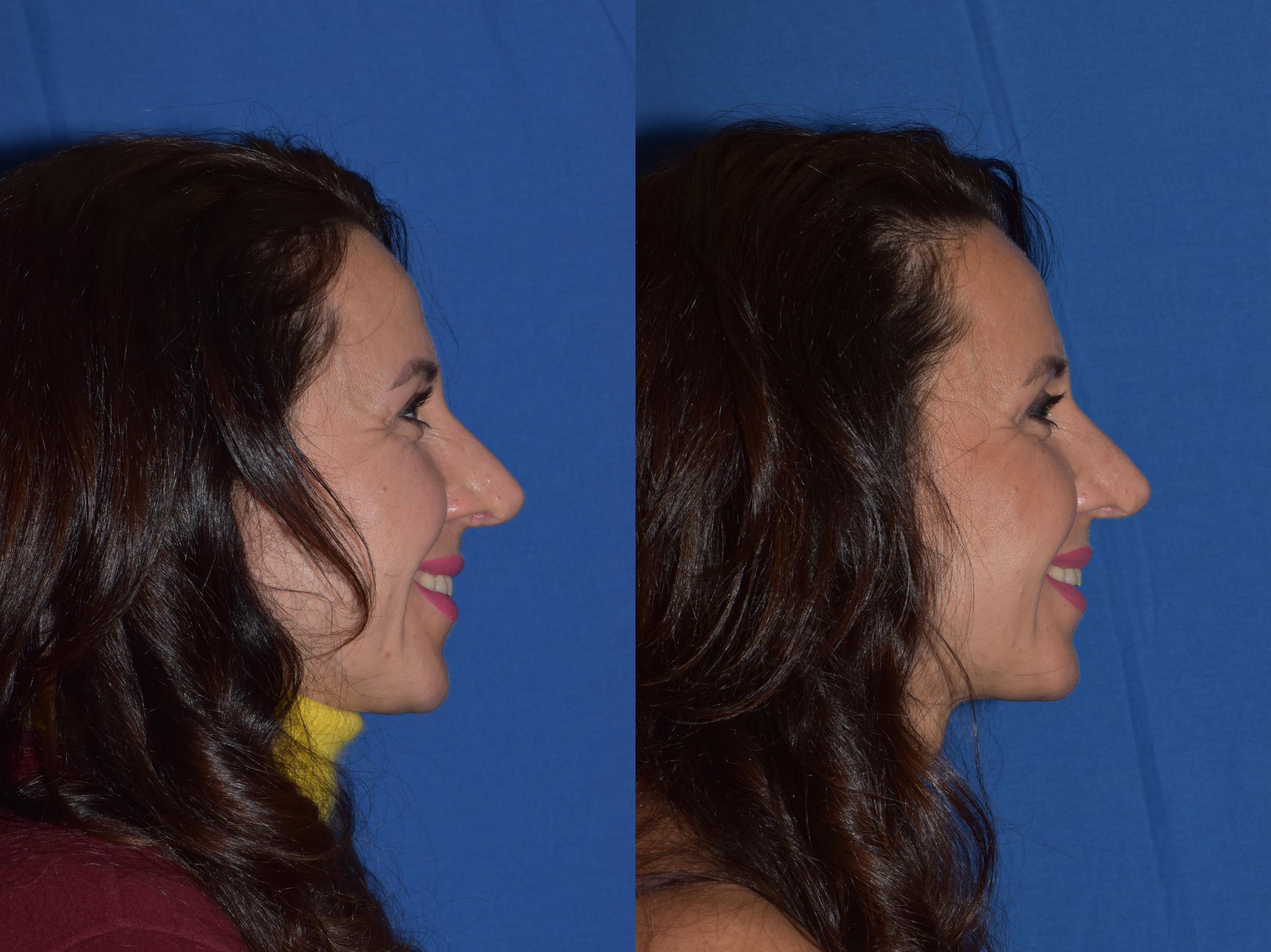 Before & After Revision Rhinoplasty Case 19 Right Side Smiling View in South Miami, Florida