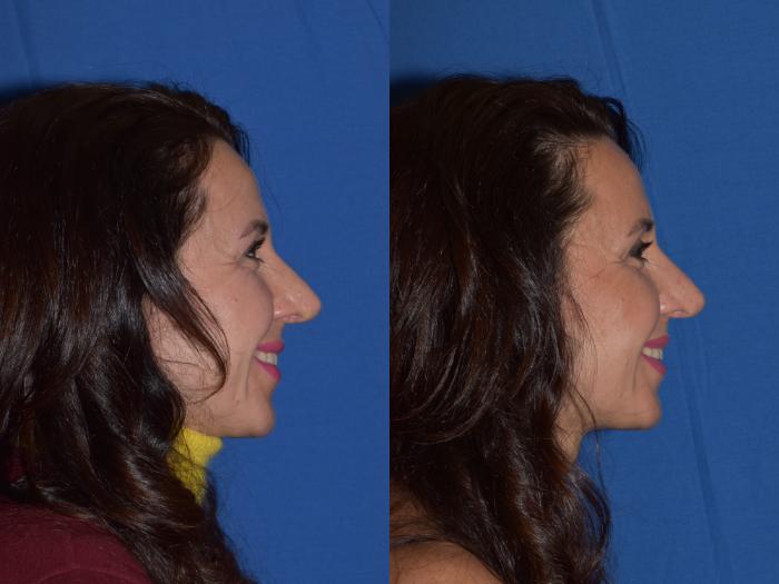 Before & After Revision Rhinoplasty Case 19 Right Side Smiling View in South Miami, Florida