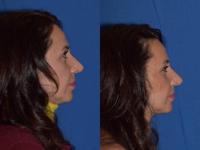 Before & After Revision Rhinoplasty Case 19 Right Side View in South Miami, Florida