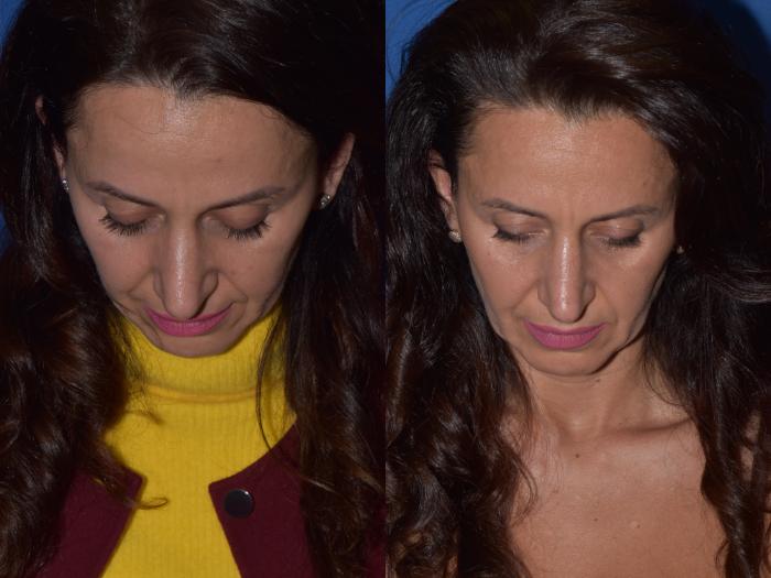 Before & After Revision Rhinoplasty Case 19 Top View in South Miami, Florida