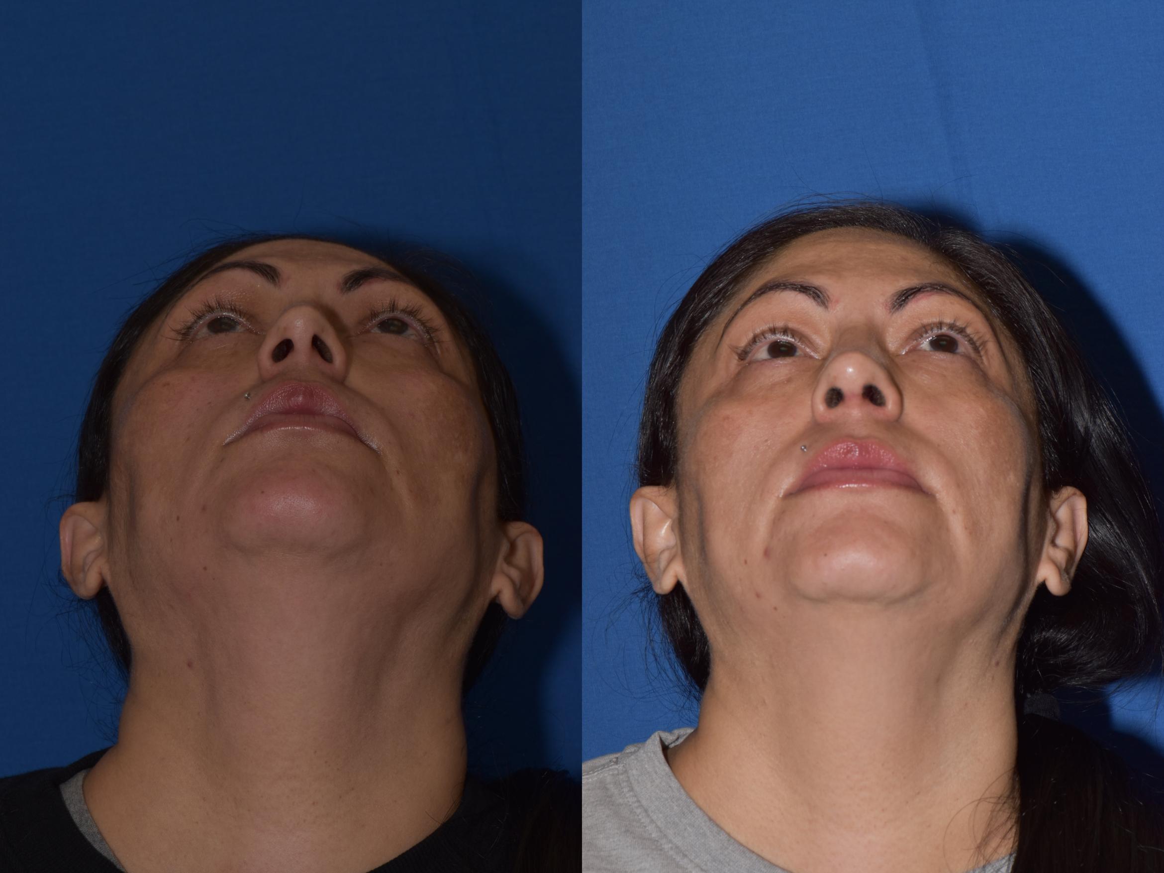 Before & After Rhinoplasty Case 1 Bottom View in South Miami, Florida