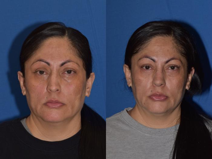 Before & After Rhinoplasty Case 1 Front View in South Miami, Florida