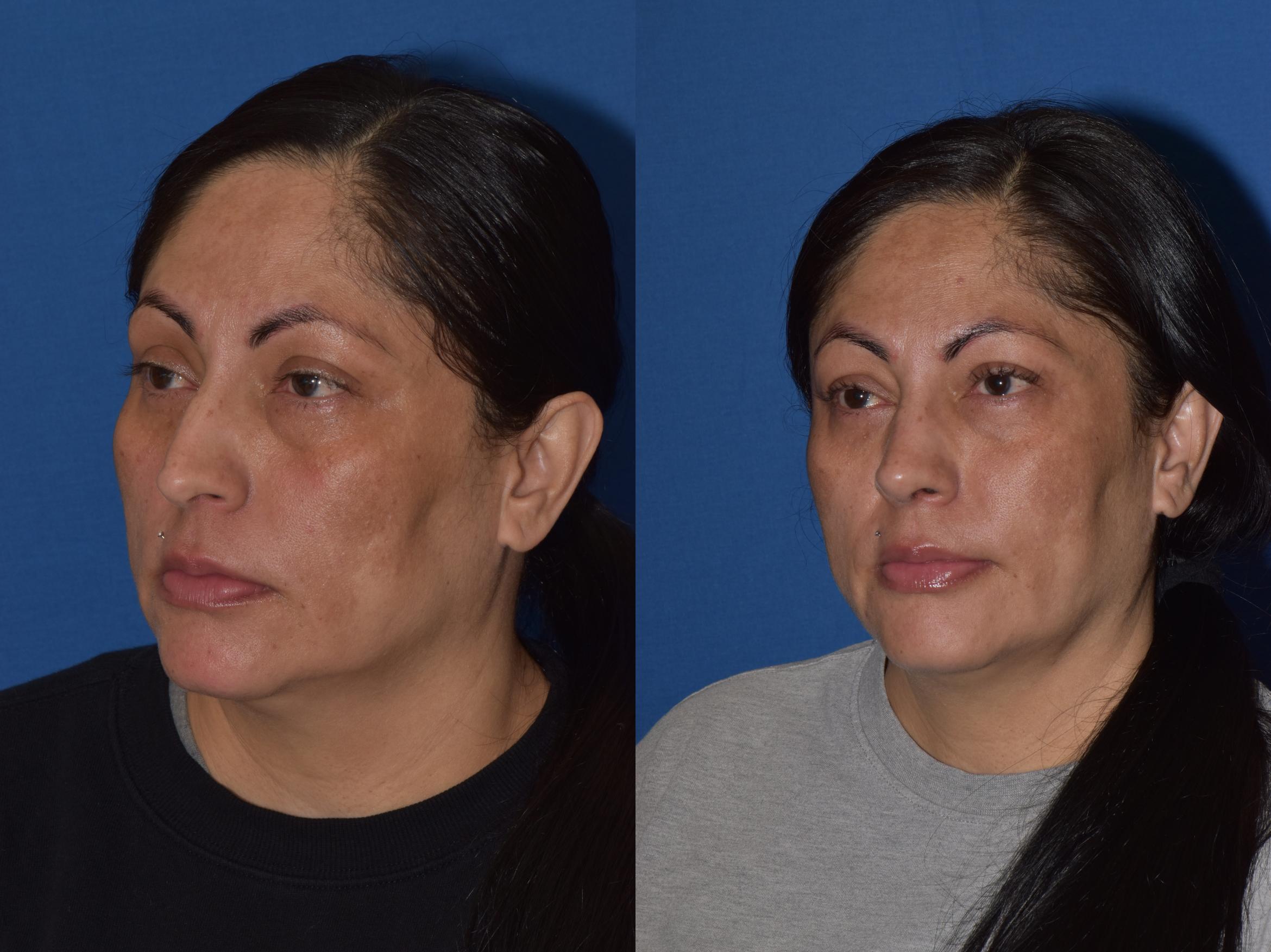 Before & After Rhinoplasty Case 1 Left Oblique View in South Miami, Florida
