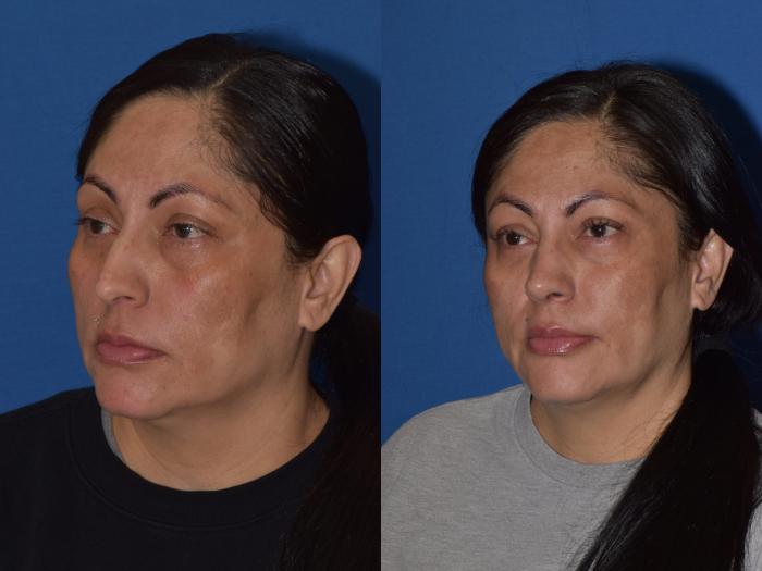 Before & After Rhinoplasty Case 1 Left Oblique View in South Miami, Florida