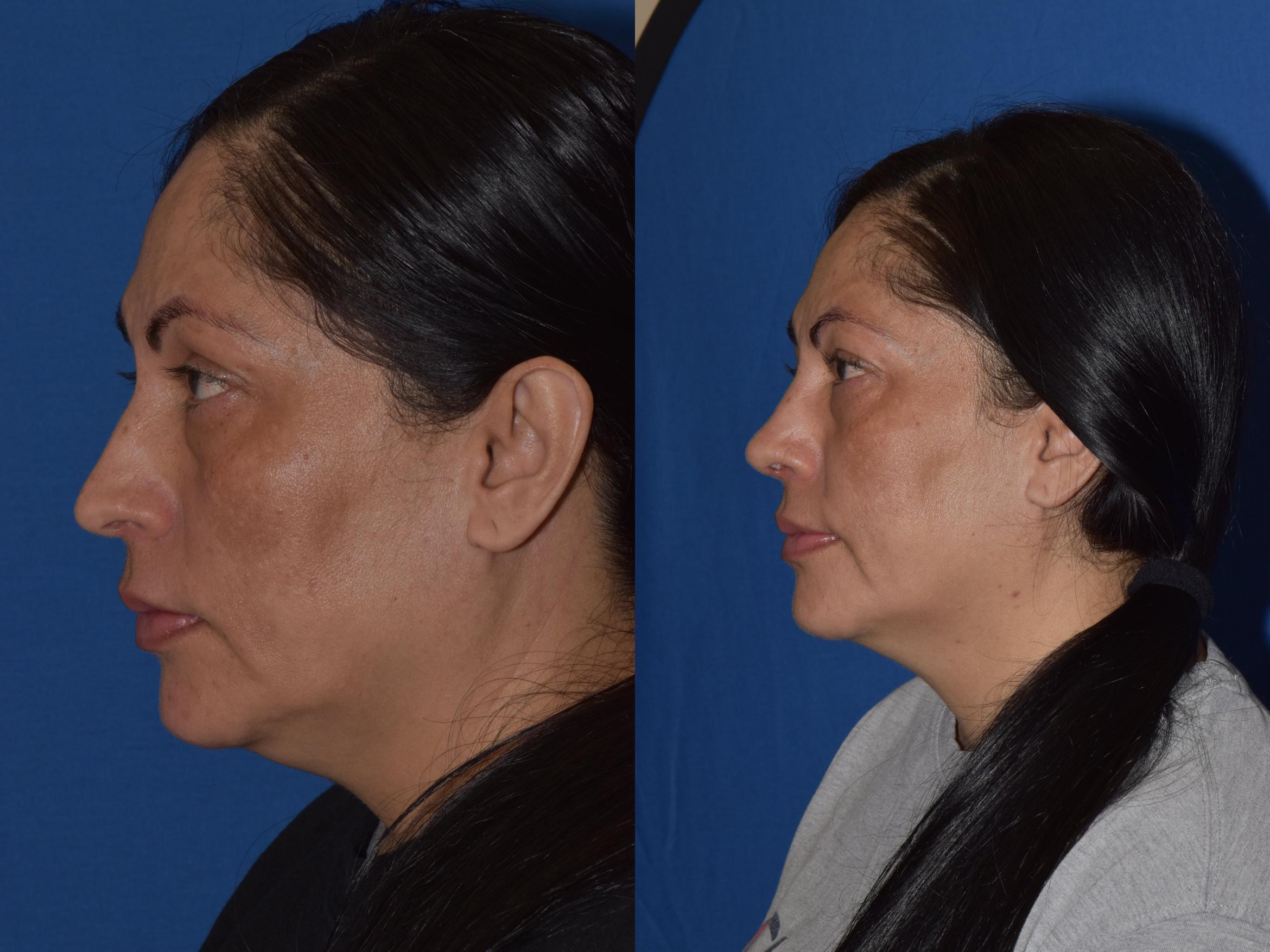 Before & After Rhinoplasty Case 1 Left Side View in South Miami, Florida