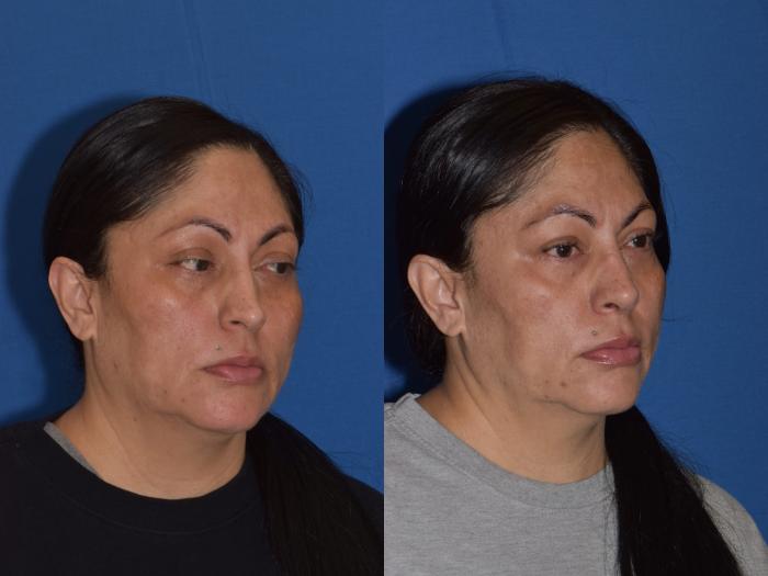 Before & After Rhinoplasty Case 1 Right Oblique View in South Miami, Florida
