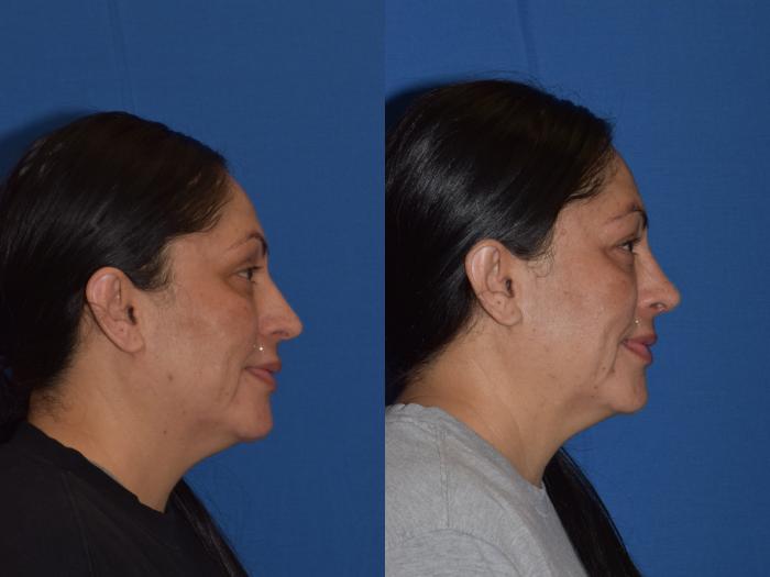 Before & After Rhinoplasty Case 1 Right Side Smiling View in South Miami, Florida