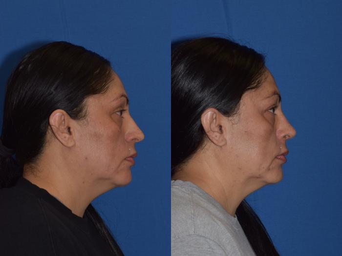 Before & After Rhinoplasty Case 1 Right Side View in South Miami, Florida