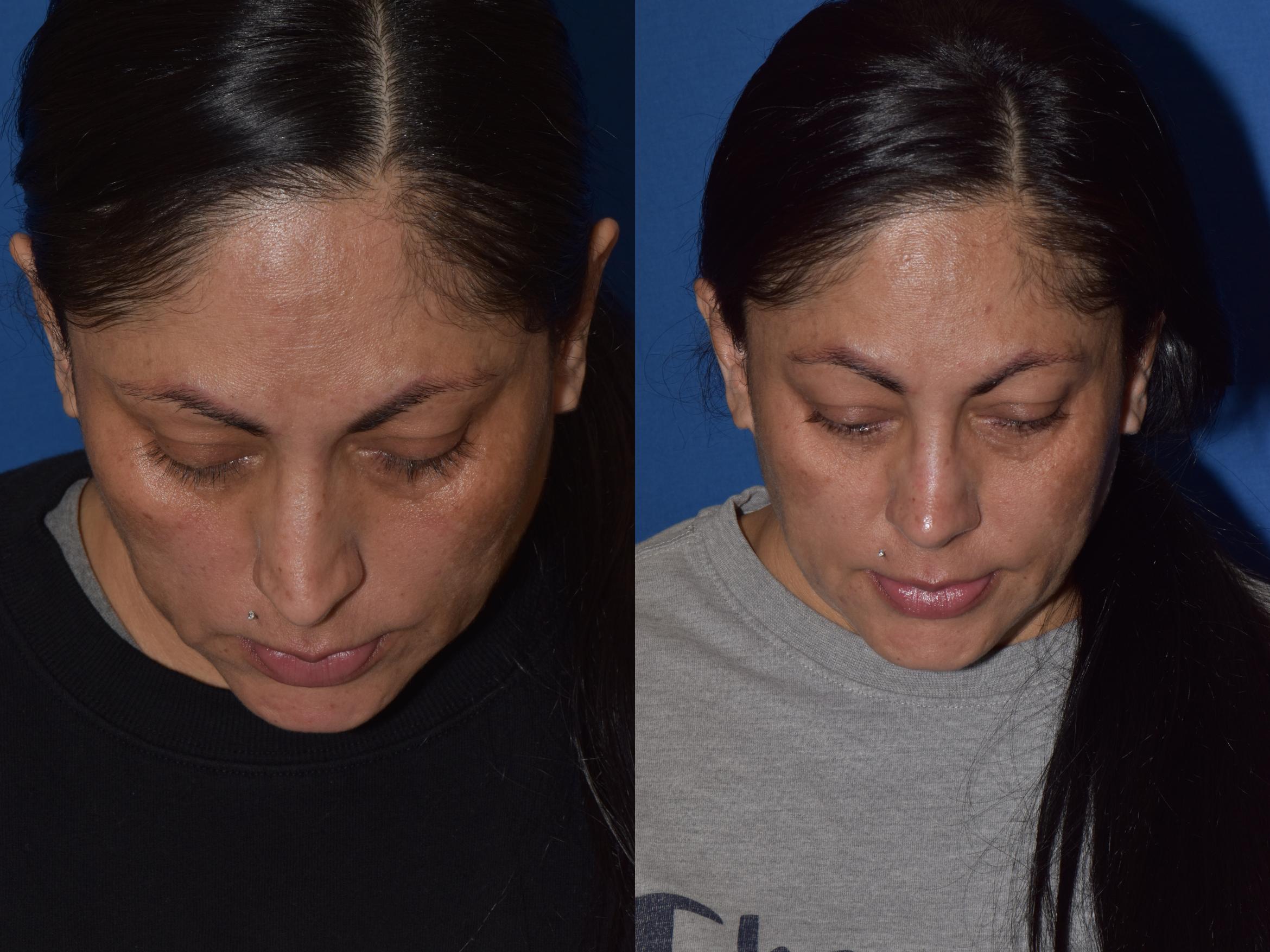 Before & After Rhinoplasty Case 1 Top View in South Miami, Florida