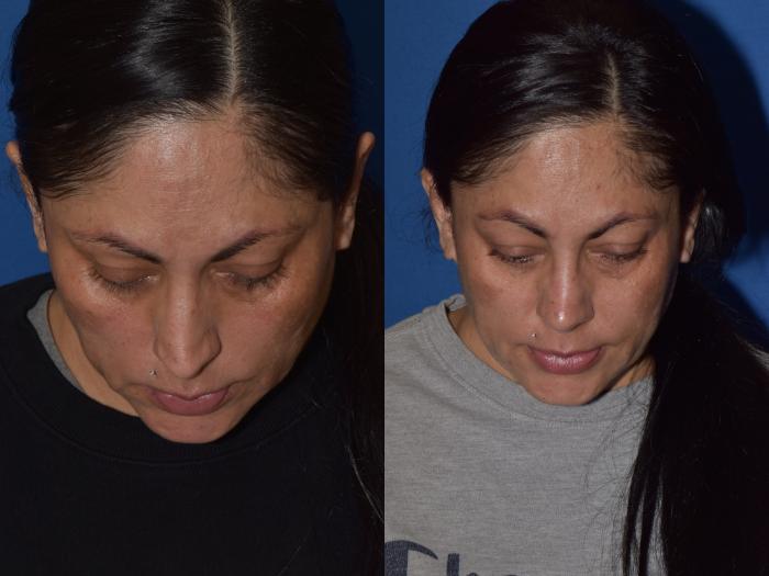 Before & After Rhinoplasty Case 1 Top View in South Miami, Florida