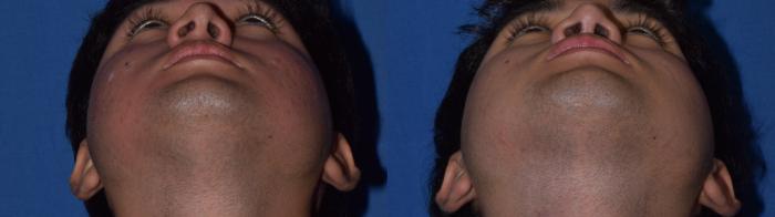 Before & After Rhinoplasty Case 10 Bottom View in South Miami, Florida