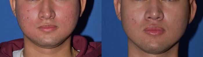 Before & After Rhinoplasty Case 10 Front View in South Miami, Florida