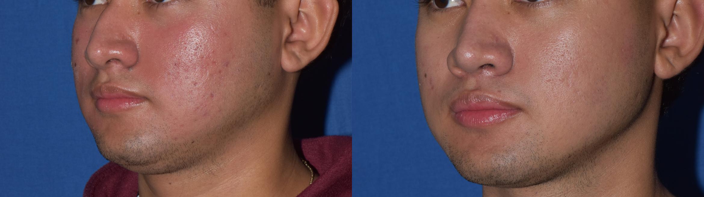 Before & After Rhinoplasty Case 10 Left Oblique View in South Miami, Florida